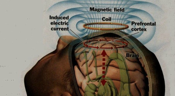 (Gambar 4 Teknik Pengobatan Electro Convulsion Therapy)