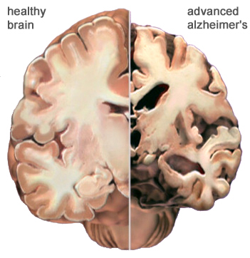 4-Perbandingan Otak Alzheimer & Normal