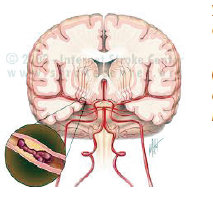 Penampakan daerah batang otak yang menderita stroke