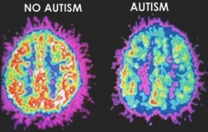 Penampakan otak penderita autisme dibanding orang normal