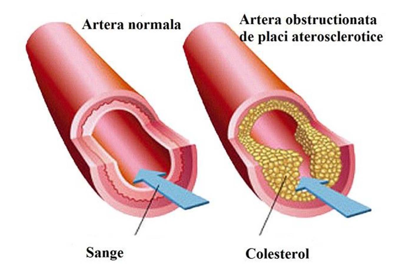 Артерий атеросклероз латынь. Атеросклероз картинки. Атеросклеротическая бляшка.